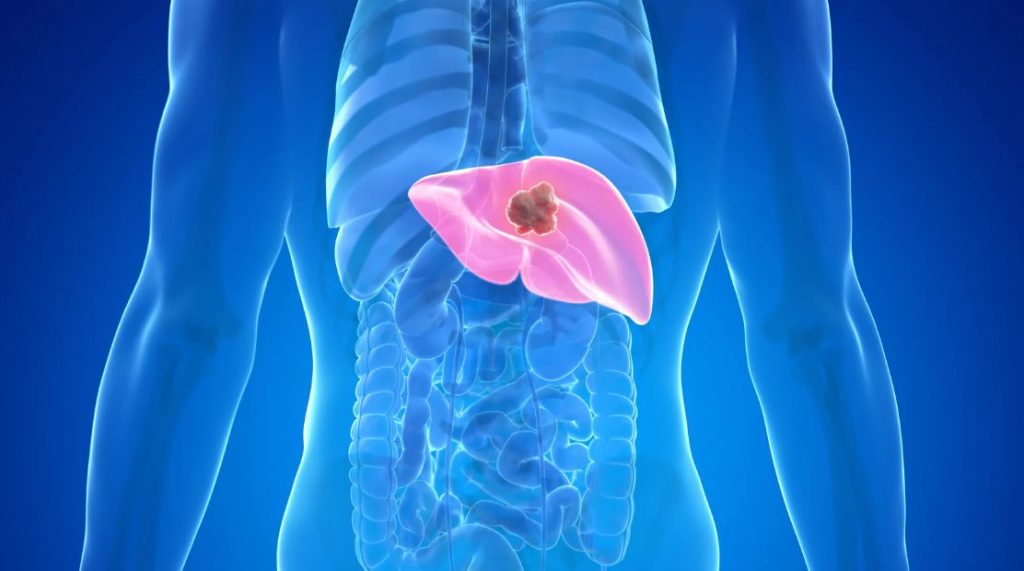 Liver Cancer